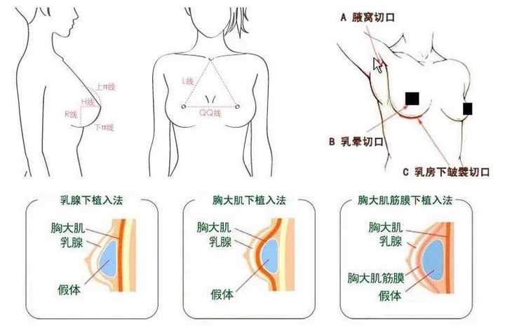 最新隆胸方法,最新隆胸方法，探索現(xiàn)代科技下的美麗新境界