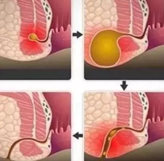 肛瘺最新治療探索，前沿技術(shù)與方法的深度研究